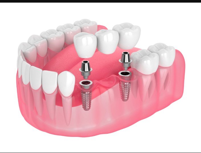 Dental Implants in Cranbourne and Expert Dental Care in Mernda: Your Comprehensive Guide to a Healthy Smile